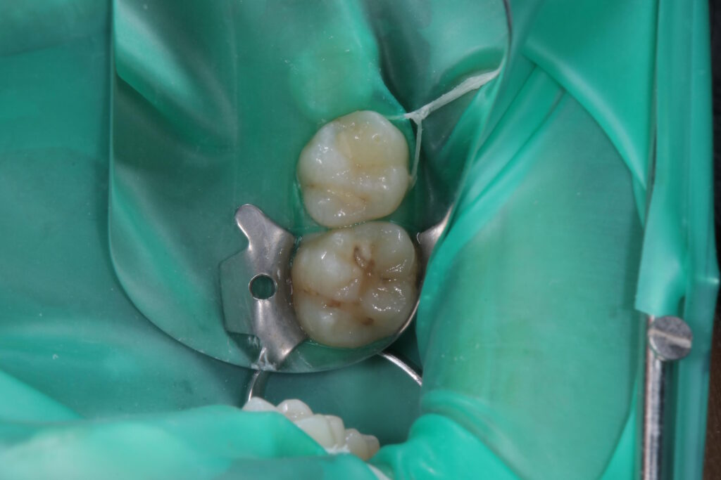 ラバーダムの使用