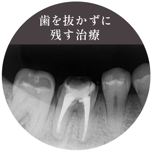 歯を抜かずに残す治療