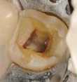 マイクロスコープでみたむし歯の写真