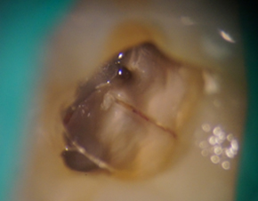 マイクロスコープで拡大した歯の破折写真