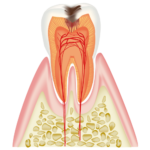 two Layers of Carious Dentin（二層のう蝕象牙質）について