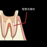 パーフォレーションのリペア
