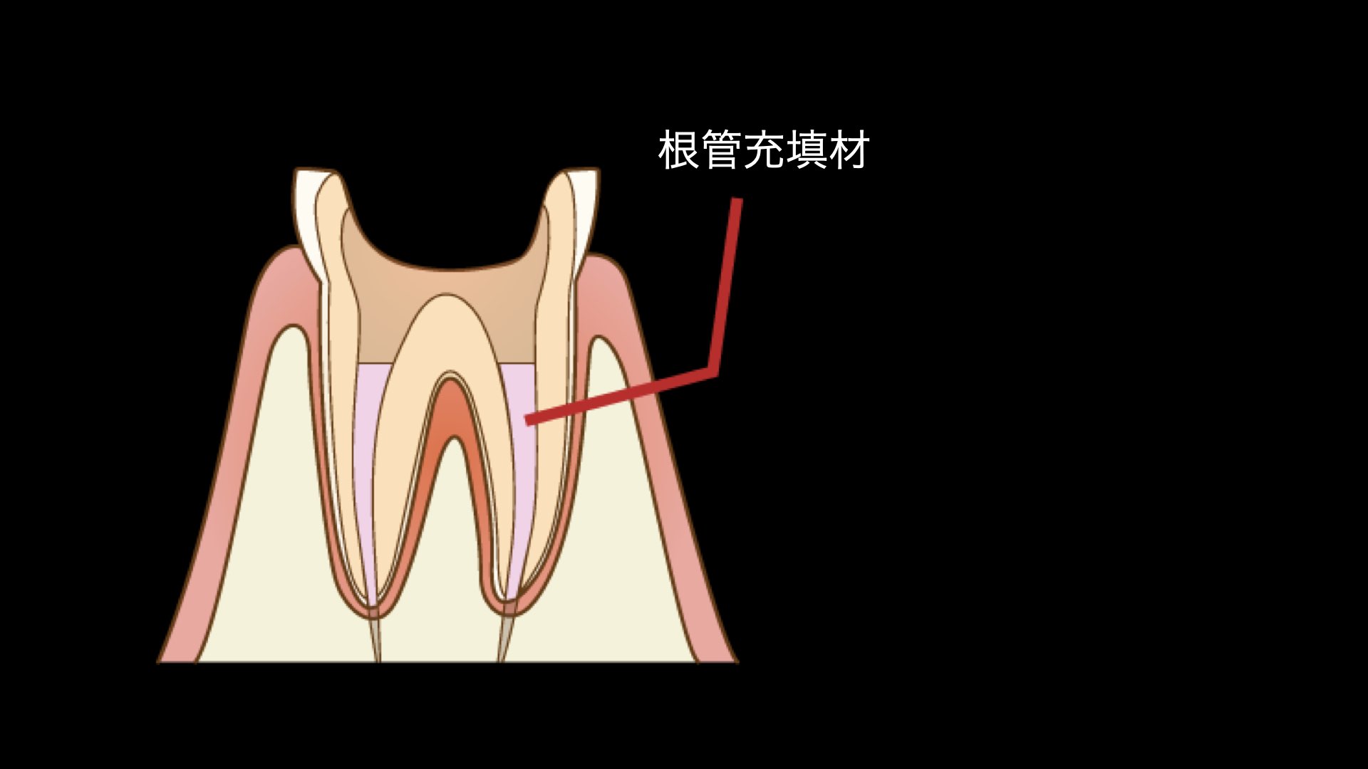 パーフォレーションのリペア