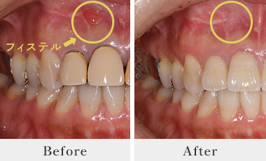 根管治療BeforeAfter