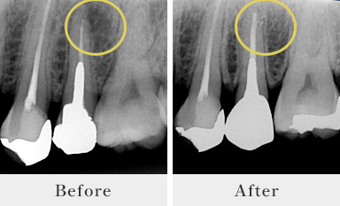 根管治療BeforeAfter