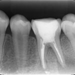 MTA充填後の再治療で歯を救えた中学生の症例